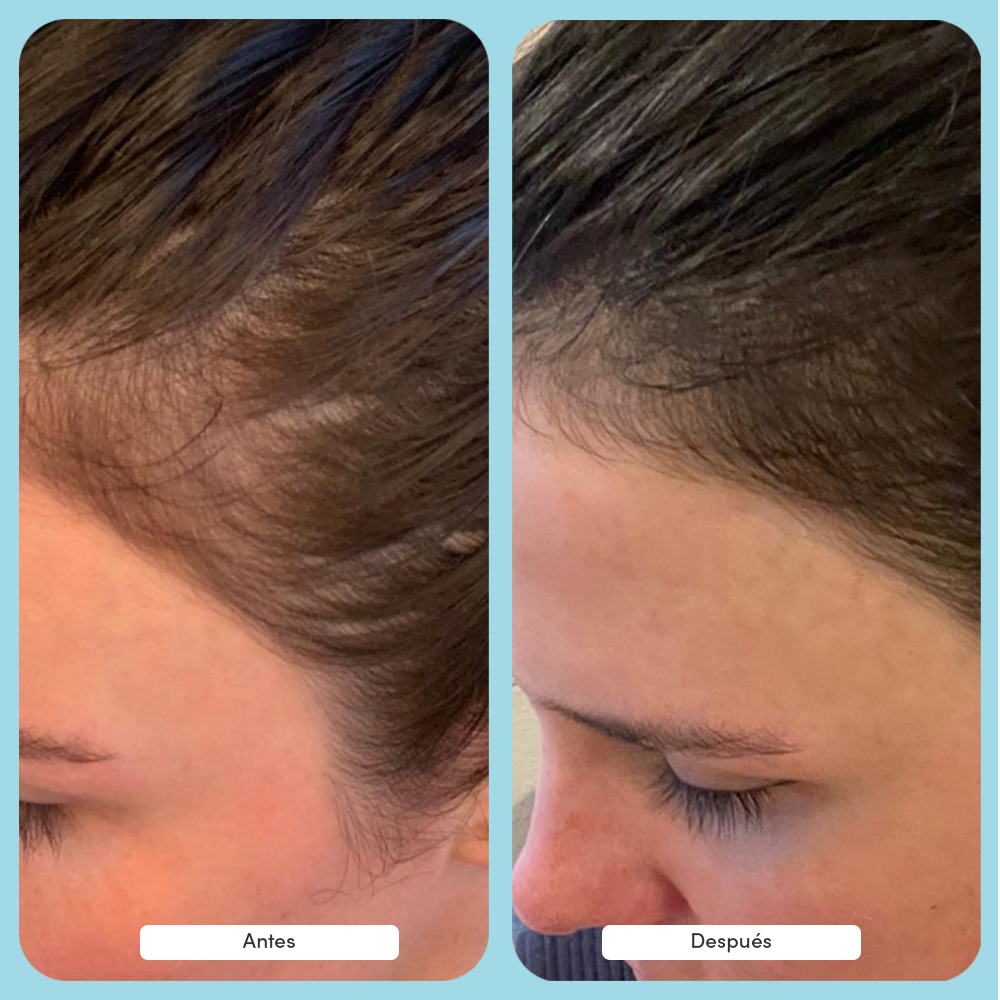 Fórmula dúo anti-caída - 1 mes