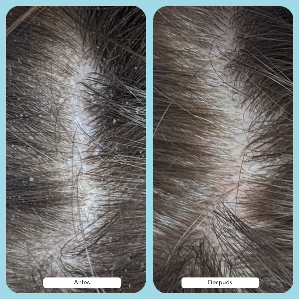 Fórmula dúo anticaspa completa - 3 meses