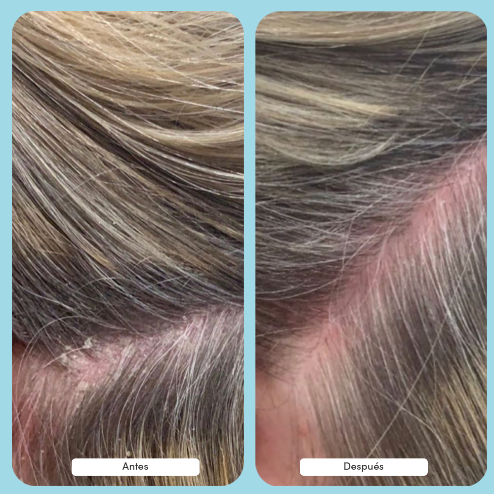 Fórmula dúo antigrasa - 1 mes